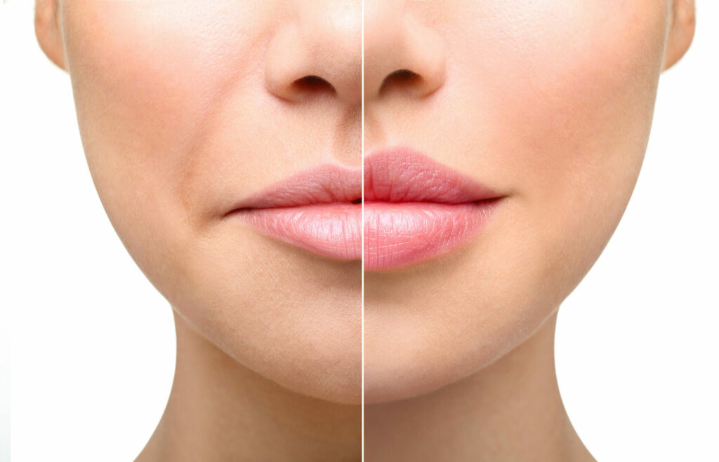 Types Of Lip Fillers