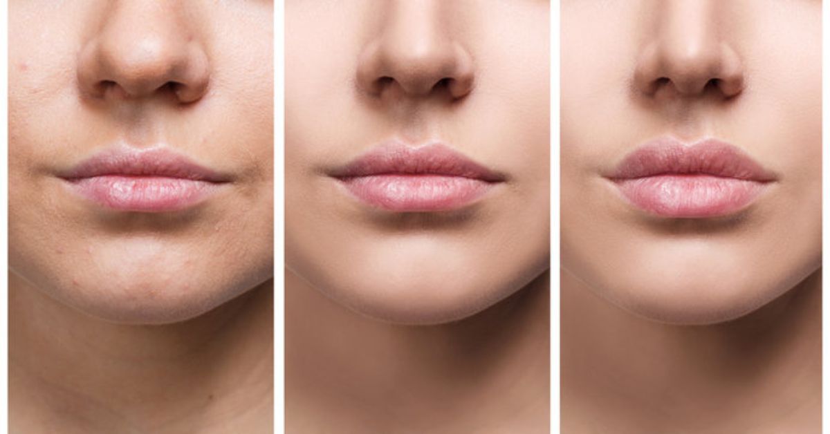 types of lip fillers