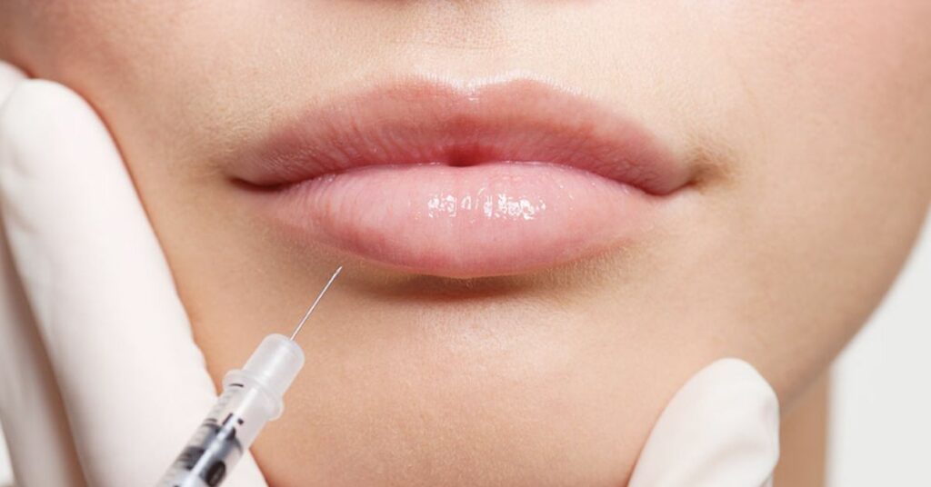 First Time Lip Fillers